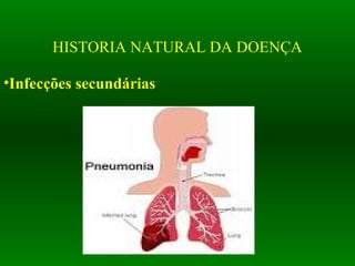 HISTORIA NATURAL DA DOENÇA
•Infecções secundárias
 
