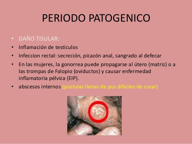 Historia Natural De La Enfermedad Gonorrea