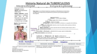 Historia natural tuberculosis.jpg