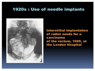 History of radiation therapy and application | PPTX