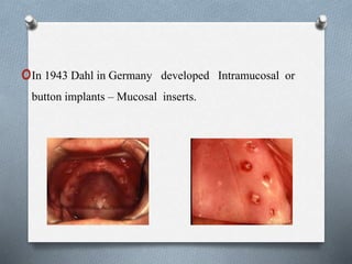 oIn 1943 Dahl in Germany developed Intramucosal or
button implants – Mucosal inserts.
 