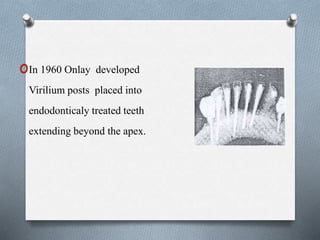 oIn 1960 Onlay developed
Virilium posts placed into
endodonticaly treated teeth
extending beyond the apex.
 