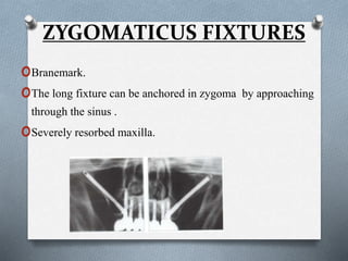 ZYGOMATICUS FIXTURES
oBranemark.
oThe long fixture can be anchored in zygoma by approaching
through the sinus .
oSeverely resorbed maxilla.
 