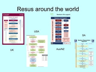 Resus around the world
www.resus.co.za
2021 2021
Provide warmth
Clear airway if necessary
Dry and stimulate
(Don’t dry if < 30 weeks – wrap preterm baby’s torso in plastic bag)
Note the time
Start ventilating with room air (Rate: 30-40/min)
Use oxygen if preterm starting at 30-40%
Connect to pulse oximeter if available, avoid hyperoxia
Ensure chest rise with each breath
Ventilate with supplemental oxygen as required
Continue ventilating with supplemental oxygen as required
Consider intubation
Start chest compressions with coordinated ventilation
(3 compressions: 1 breath)
Each cycle should take 2 seconds
Continue compressions and ventilation
Give 0.1-0.3ml/kg Adrenaline IV (1:10 000 dilution)
(1ml/kg Adrenaline ETT (1:10 000 dilution) only if no IV access)
May repeat Adrenaline IV after 3-5 minutes
Correct hypovolaemia if necessary
(10ml/kg normal saline over 5-10 minutes)
Consider pneumothorax/Check glucose
Newborn Resuscitation
Algorithm
Assess breathing/crying and/or
heart rate
Gasping, apnoeic or heart rate < 100?
Heart rate < 100?
Heart rate < 60?
Heart rate < 60?
Assess breathing, heart rate and SATS/colour
every 30-60s
Assess breathing, heart rate and SATS/colour
every 30-60 seconds
Assess breathing, heart rate and SATS/colour
every 30-60 seconds
Term gestation?
Breathing? Good tone?
Routine care with mother
If ongoing respiratory distress
- consider CPAP
Yes
Yes
Yes
Yes
No
Yes
MAINTAIN
NORMOTHERMIA
GOLDEN
MINUTE
(BIRTH
–
60
sec)
Oxygen administration
Use blended oxygen if available
to achieve targeted
pre-ductal sats
Alternatively:
Bag with no O2 = 21%
Bag with O2 = 40%
Bag with O2 + res ervoir bag ≈ 100%
Normal pre-ductal
sats after birth
(right hand or ear)
1 min: > 60%
2 min: > 65%
3 min: > 70%
4 min: > 75%
5 min: > 80%
> 10 min: 90-95%
Post-resuscitation care
Maintain normothermia:
36.5-37.5° C
Consider induced hypothermia
where available according
to protocol
If ongoing respiratory distress
consider nasal CPAP and surfactant
as required according to protocol
Maintain sats 90-95%
SA
USA
UK Aus/NZ
 