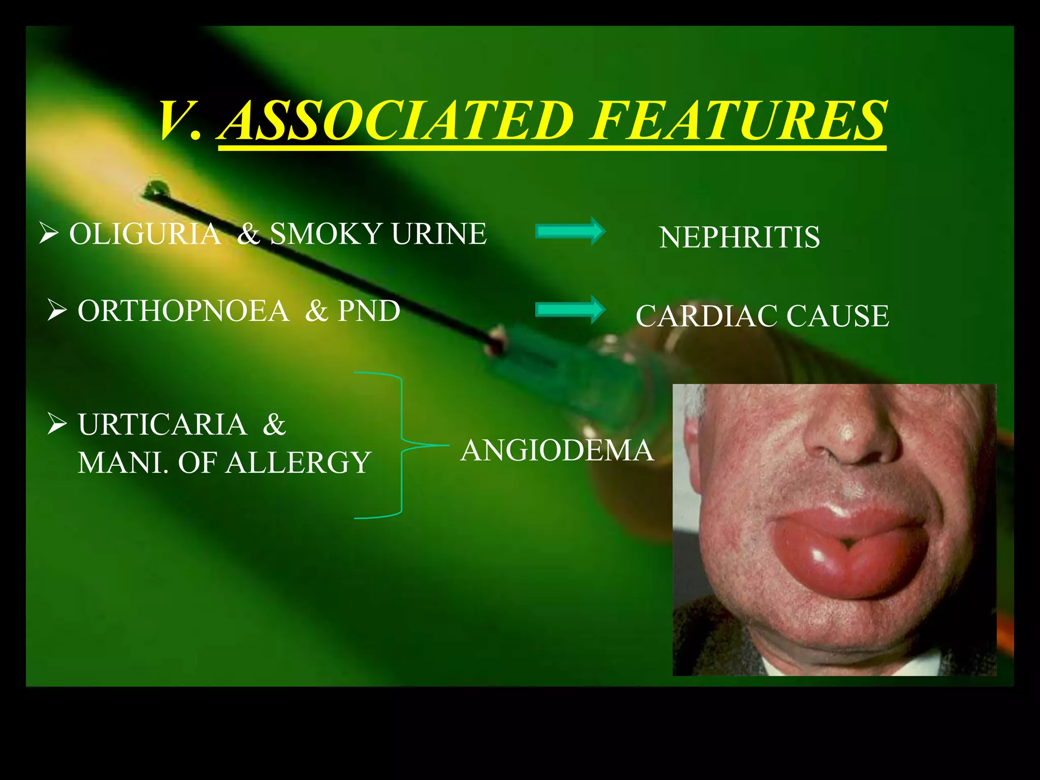 V. ASSOCIATED FEATURES
 OLIGURIA & SMOKY URINE          NEPHRITIS

 ORTHOPNOEA & PND            CARDIAC CAUSE


 URTICARIA &
  MANI. OF ALLERGY    ANGIODEMA
 