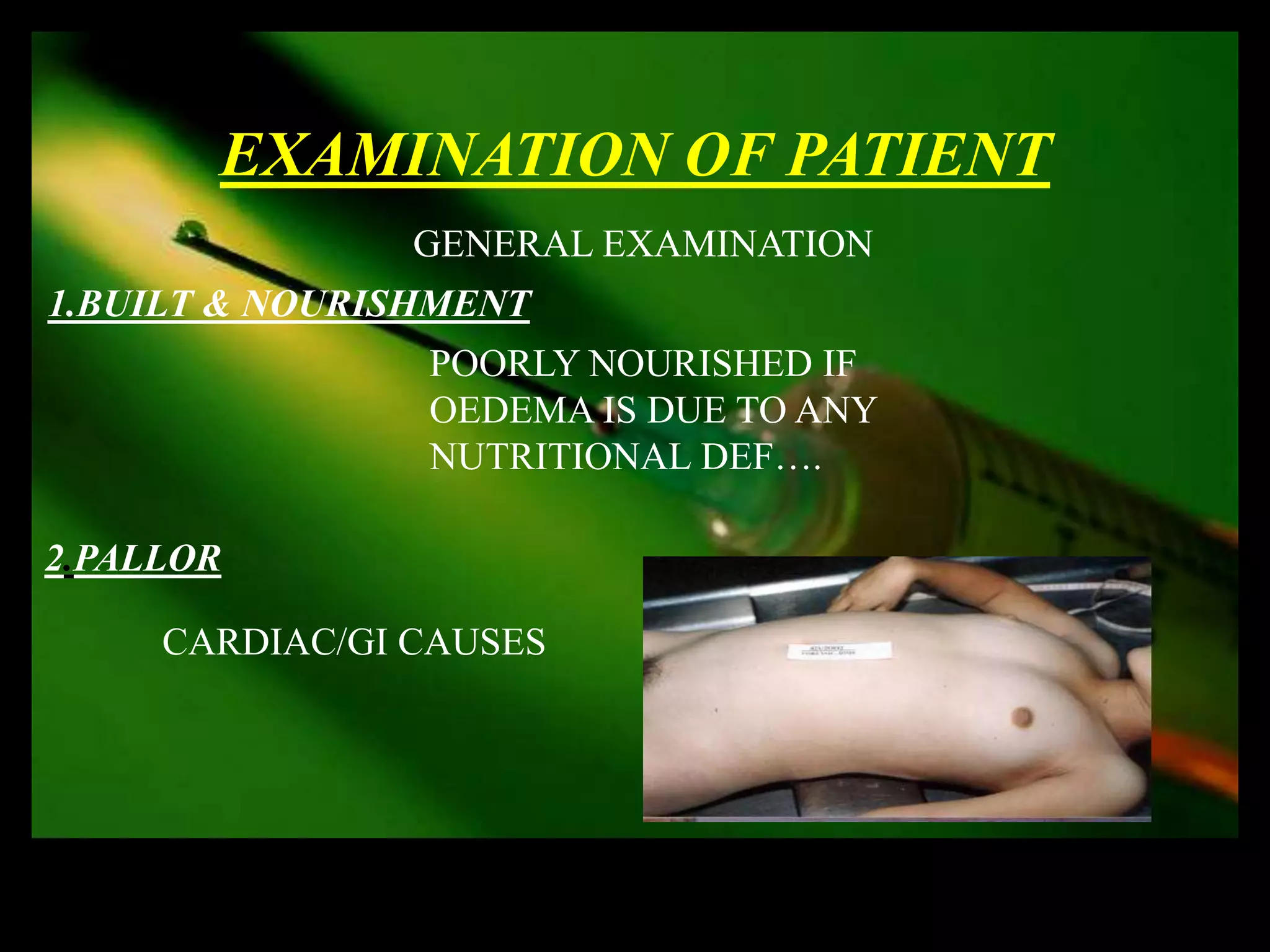 EXAMINATION OF PATIENT
                GENERAL EXAMINATION
1.BUILT & NOURISHMENT
                POORLY NOURISHED IF
                OEDEMA IS DUE TO ANY
                NUTRITIONAL DEF….

2.PALLOR

     CARDIAC/GI CAUSES
 