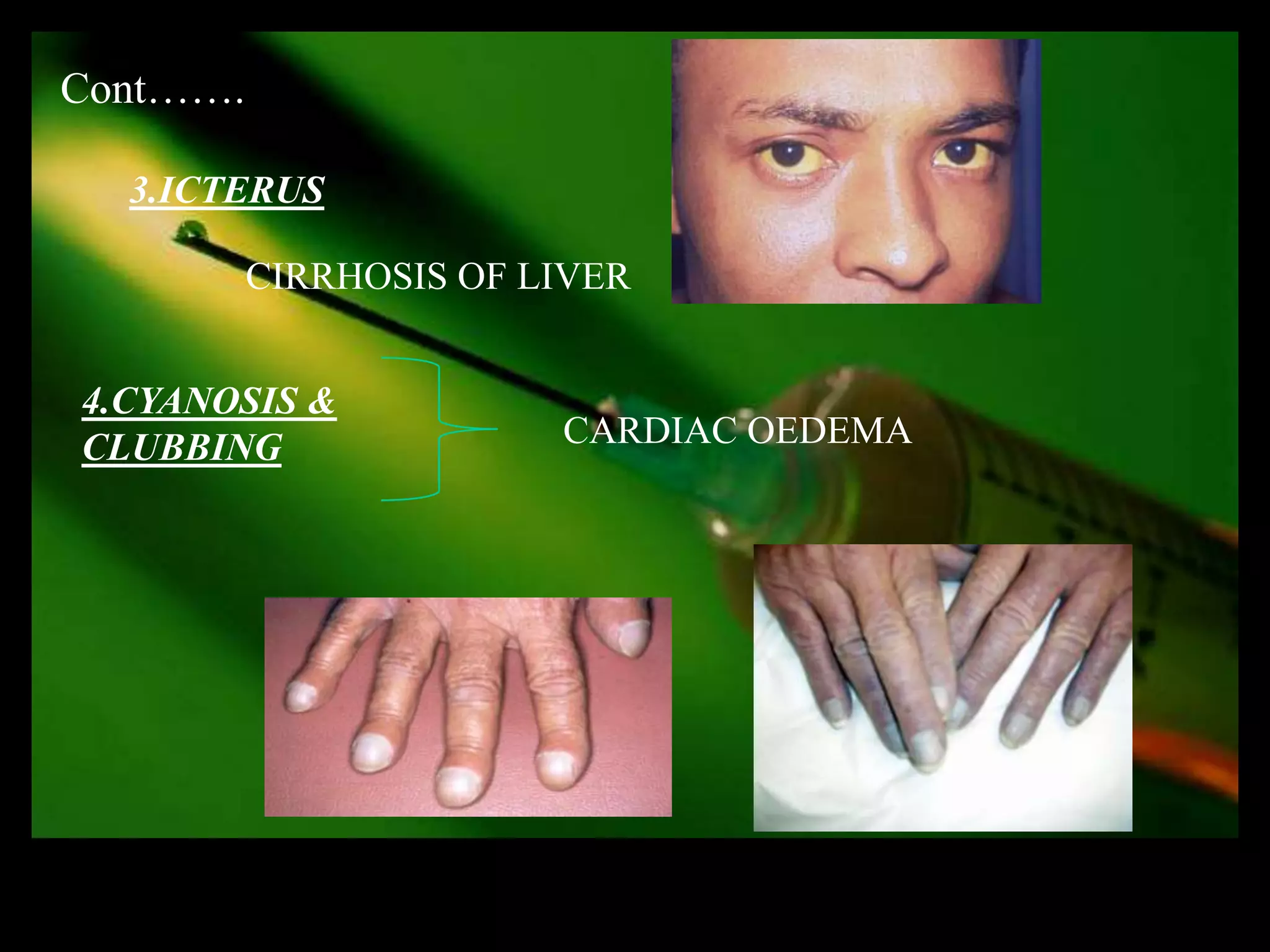 Cont…….

  3.ICTERUS

          CIRRHOSIS OF LIVER


4.CYANOSIS &
CLUBBING                CARDIAC OEDEMA
 