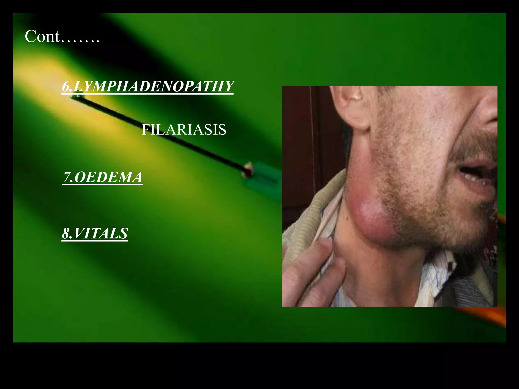 Cont…….

   6.LYMPHADENOPATHY

              FILARIASIS


   7.OEDEMA


   8.VITALS
 