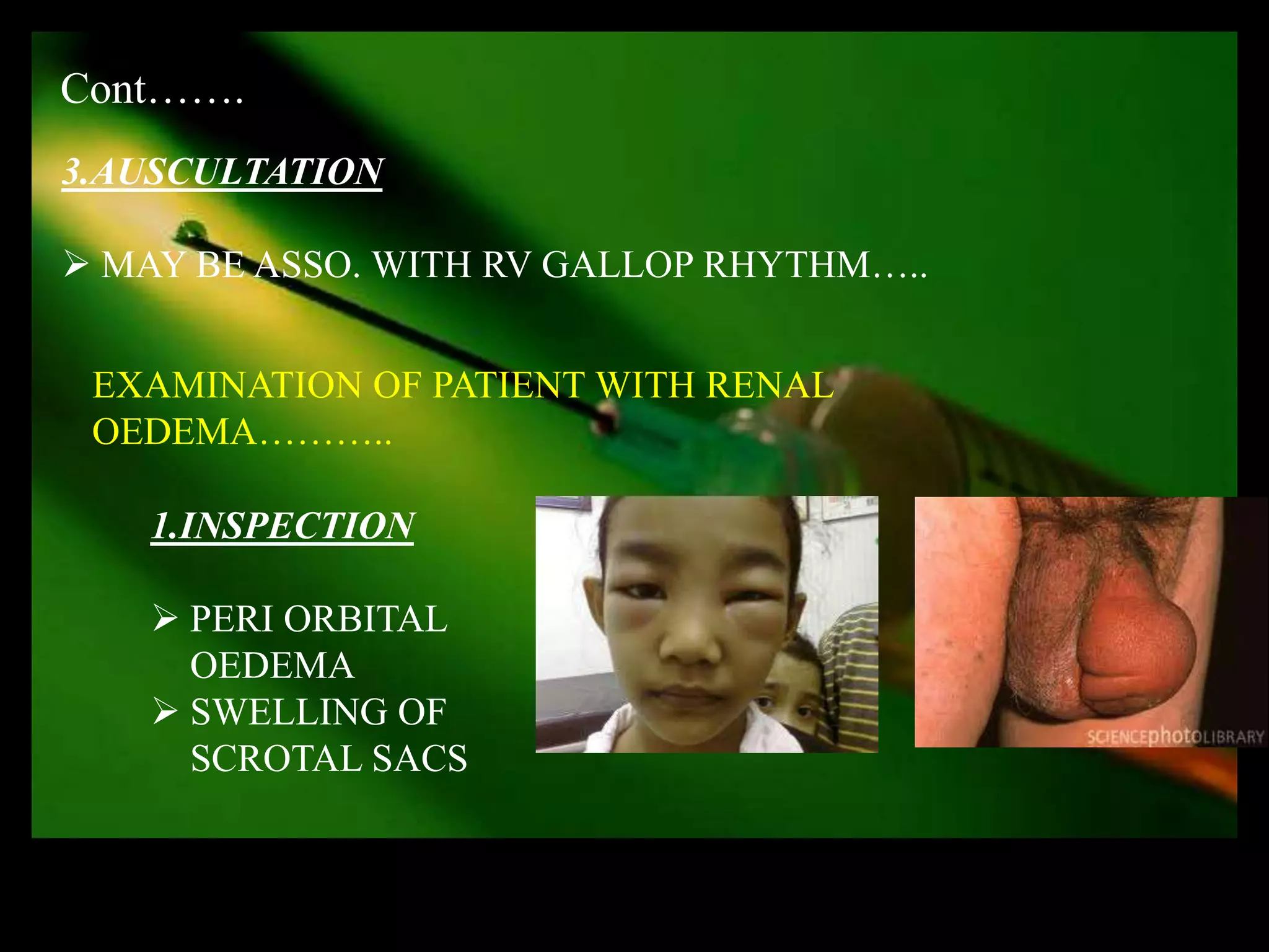 Cont…….
3.AUSCULTATION

 MAY BE ASSO. WITH RV GALLOP RHYTHM…..


 EXAMINATION OF PATIENT WITH RENAL
 OEDEMA………..

   1.INSPECTION

    PERI ORBITAL
     OEDEMA
    SWELLING OF
     SCROTAL SACS
 