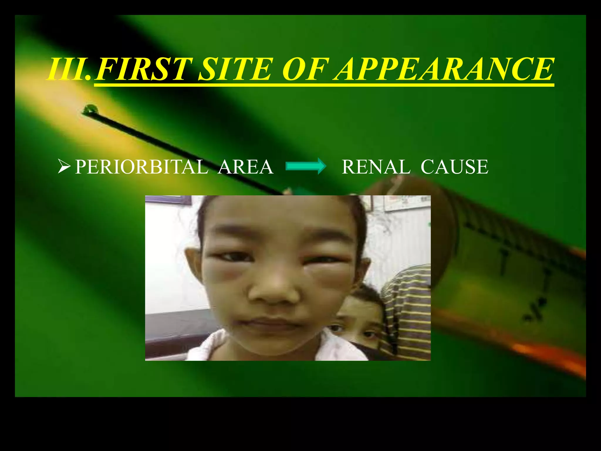 III.FIRST SITE OF APPEARANCE

 PERIORBITAL AREA   RENAL CAUSE
 