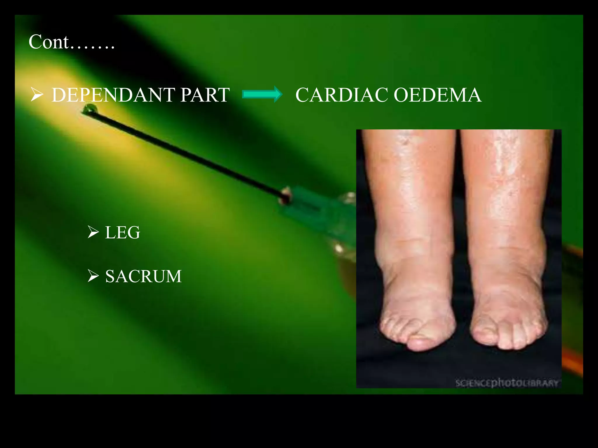 Cont…….

 DEPENDANT PART   CARDIAC OEDEMA




     LEG

     SACRUM
 