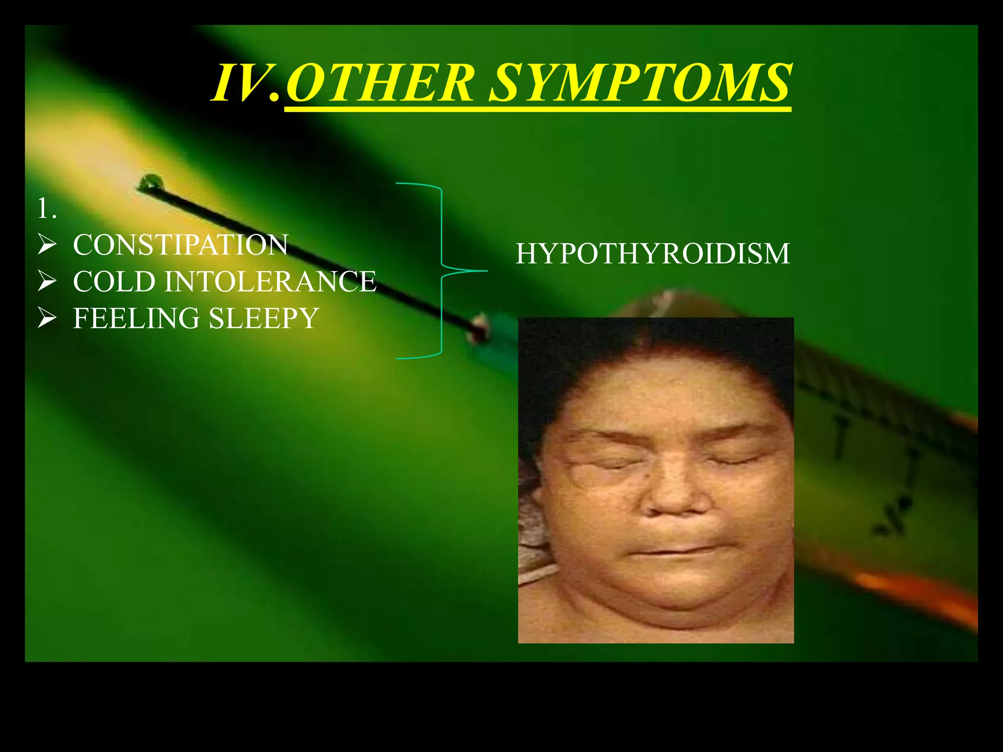 IV.OTHER SYMPTOMS

1.
 CONSTIPATION       HYPOTHYROIDISM
 COLD INTOLERANCE
 FEELING SLEEPY
 
