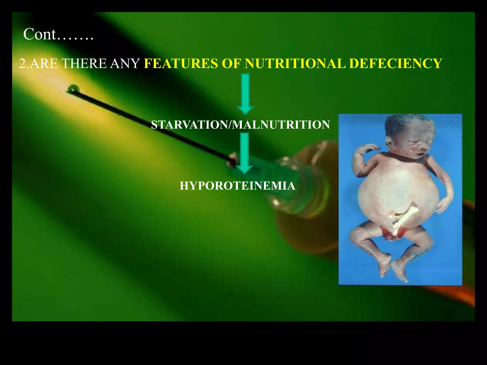 Cont…….
2.ARE THERE ANY FEATURES OF NUTRITIONAL DEFECIENCY



               STARVATION/MALNUTRITION




                  HYPOROTEINEMIA
 