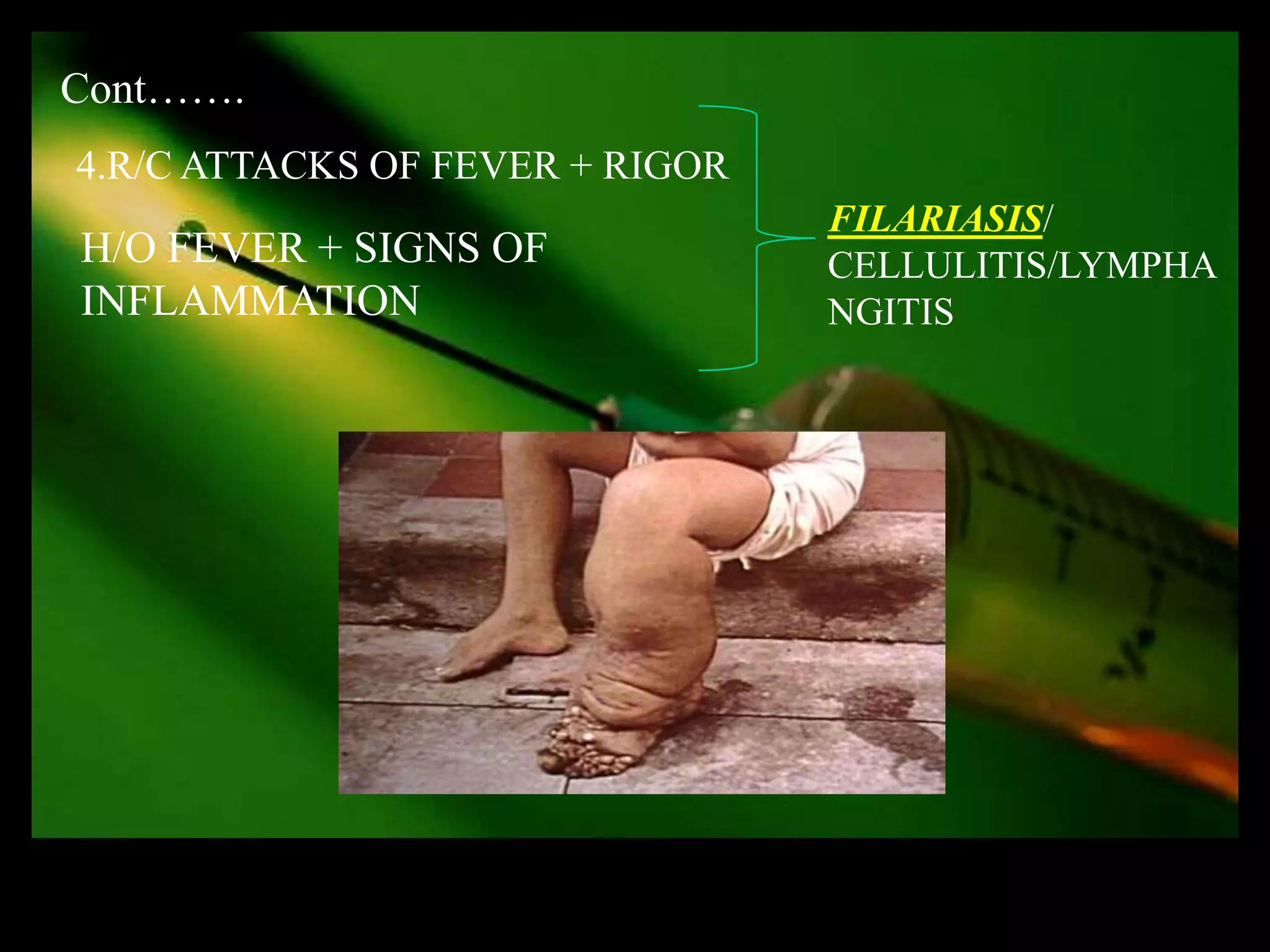 Cont…….
4.R/C ATTACKS OF FEVER + RIGOR
                                 FILARIASIS/
H/O FEVER + SIGNS OF             CELLULITIS/LYMPHA
INFLAMMATION                     NGITIS
 