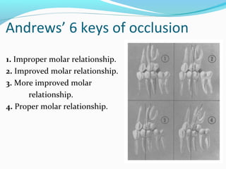Andrews’ 6 keys of occlusion
1. Improper molar relationship.
2. Improved molar relationship.
3. More improved molar
relationship.
4. Proper molar relationship.
 