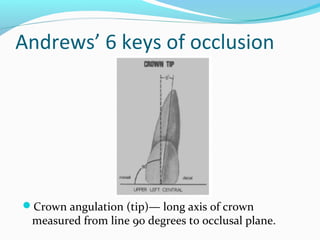 Andrews’ 6 keys of occlusion
Crown angulation (tip)— long axis of crown
measured from line 90 degrees to occlusal plane.
 