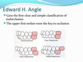 Edward H. Angle
Gave the first clear and simple classification of
malocclusion
The upper first molars were the key to occlusion
 