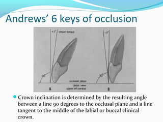 Andrews’ 6 keys of occlusion
Crown inclination is determined by the resulting angle
between a line 90 degrees to the occlusal plane and a line
tangent to the middle of the labial or buccal clinical
crown.
 