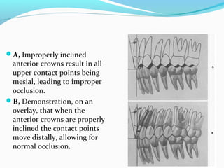 A, Improperly inclined
anterior crowns result in all
upper contact points being
mesial, leading to improper
occlusion.
B, Demonstration, on an
overlay, that when the
anterior crowns are properly
inclined the contact points
move distally, allowing for
normal occlusion.
 