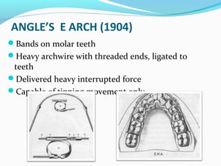 ANGLE’S E ARCH (1904)
Bands on molar teeth
Heavy archwire with threaded ends, ligated to
teeth
Delivered heavy interrupted force
Capable of tipping movement only
 