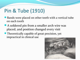 Pin & Tube (1910)
Bands were placed on other teeth with a vertical tube
on each tooth
A soldered pin from a smaller arch wire was
placed, and position changed every visit
Theoretically capable of great precision, yet
impractical in clinical use
 