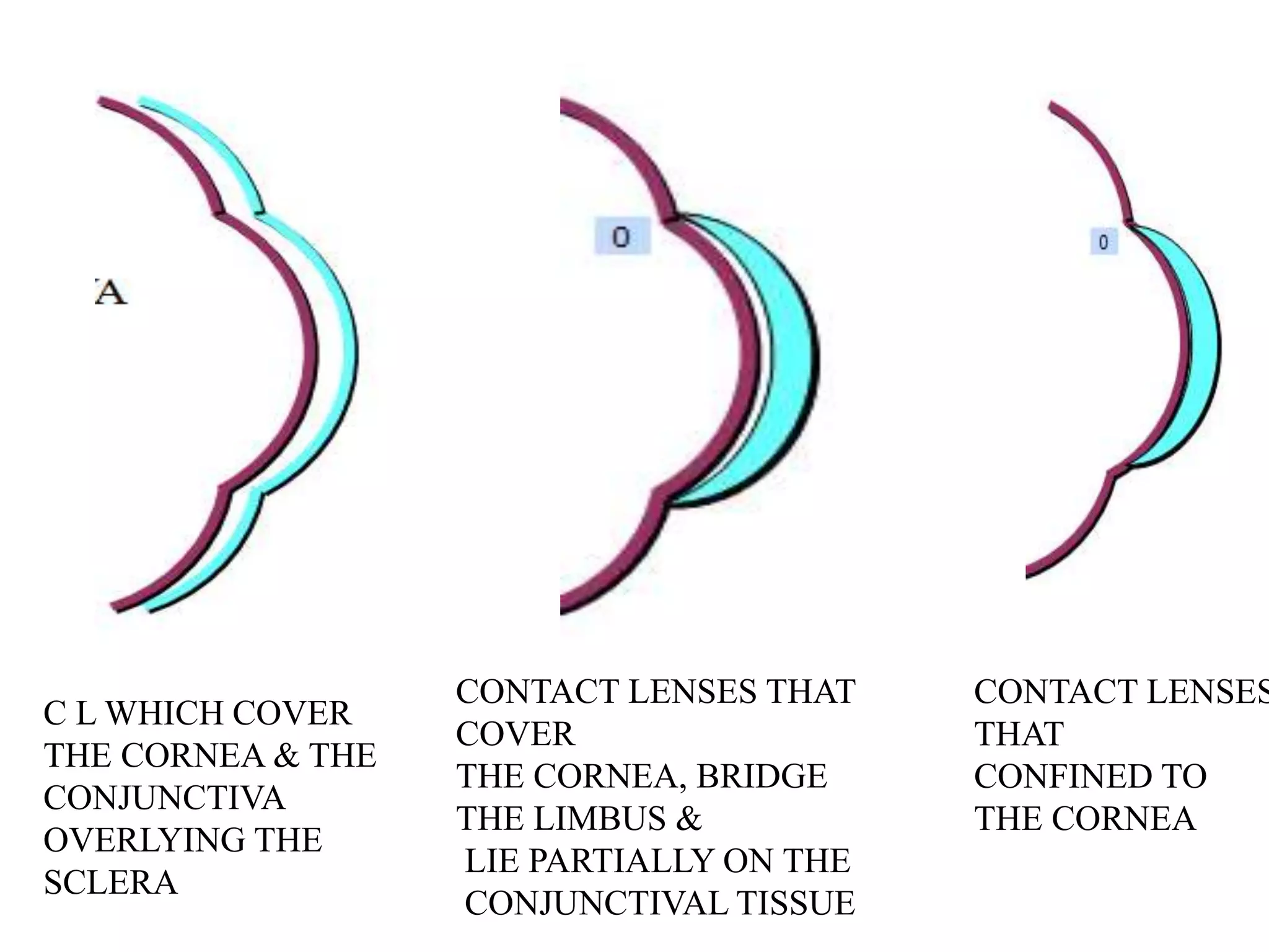 C L WHICH COVER
THE CORNEA & THE
CONJUNCTIVA
OVERLYING THE
SCLERA
CONTACT LENSES THAT
COVER
THE CORNEA, BRIDGE
THE LIMBUS &
LIE PARTIALLY ON THE
CONJUNCTIVAL TISSUE
CONTACT LENSES
THAT
CONFINED TO
THE CORNEA
 