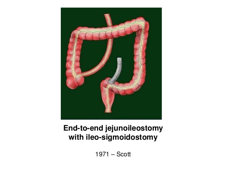 History of bariatric surgery