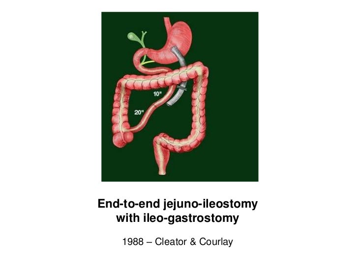 History of bariatric surgery