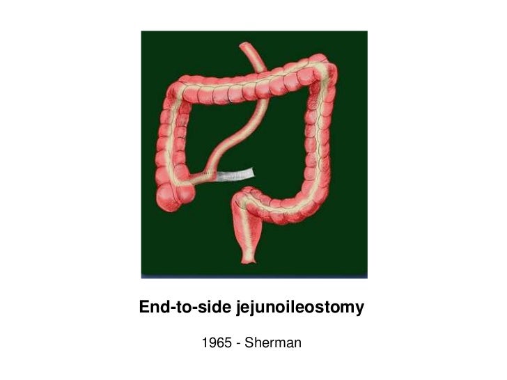 History of bariatric surgery