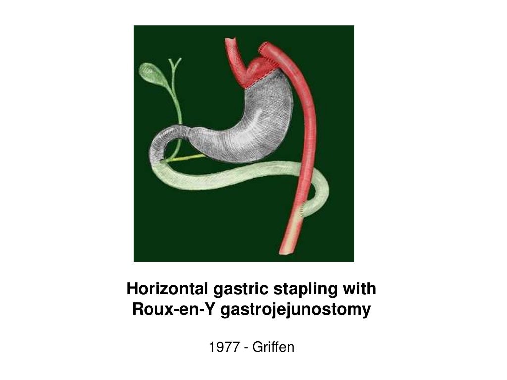 History of bariatric surgery