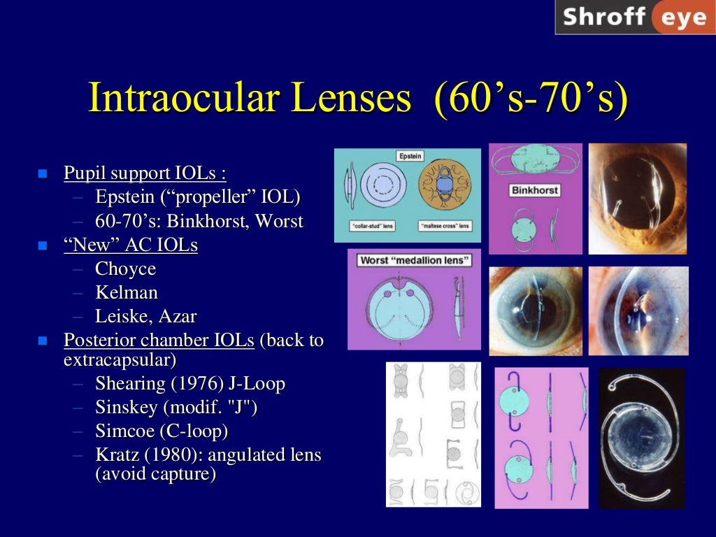 History of Cataract Surgery