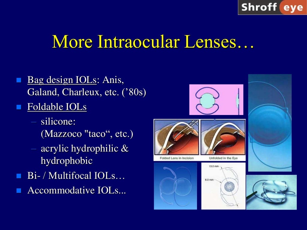 History of Cataract Surgery