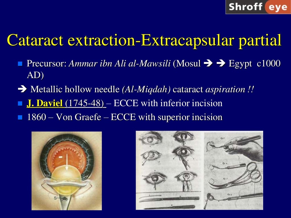 History of Cataract Surgery