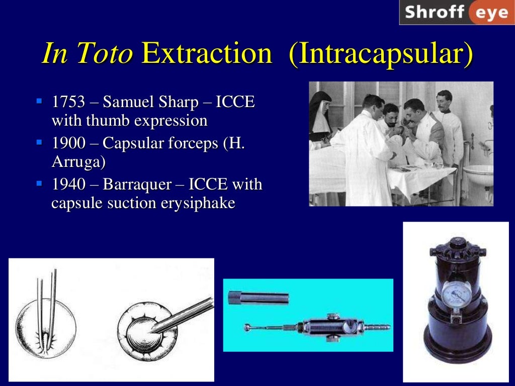 History of Cataract Surgery