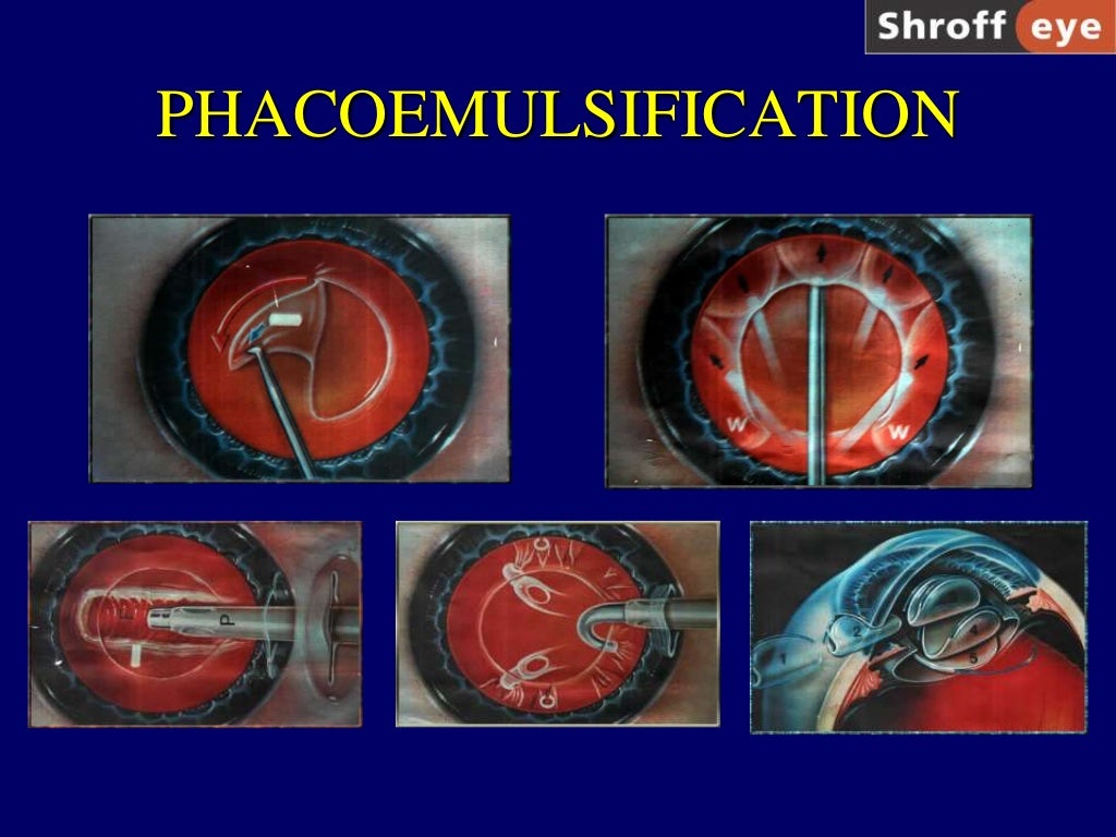 History of Cataract Surgery