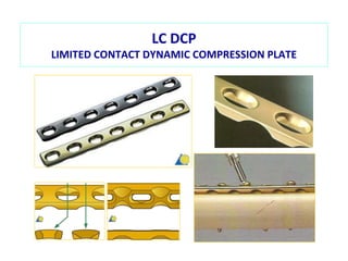 Lc Compression History of fracture fixation part 2 | PPTX