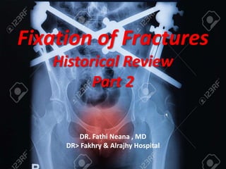 Fixation of Fractures
Historical Review
Part 2
DR. Fathi Neana , MD
DR> Fakhry & Alrajhy Hospital
 