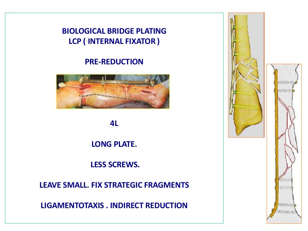 History of fracture fixation part 2