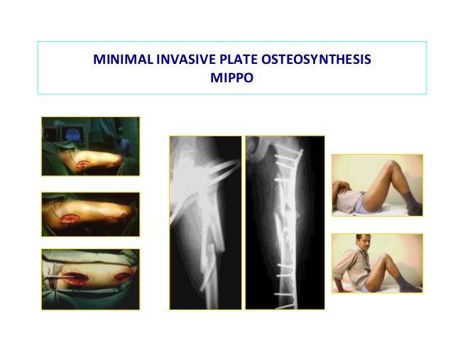 biological osteosynthesis Abstract = osteochondral lesions of the dome of the talus whether medial or lateral are rare surgical treatment is required when there is a loose body, or when the lesion is symptomatic and resistants to nonsurgical treatment. biological osteosynthesis Abstract = osteochondral lesions of the dome of the talus whether medial or lateral are rare surgical treatment is required when there is a loose body, or when the lesion is symptomatic and resistants to nonsurgical treatment.