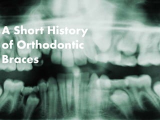 A Short History
of Orthodontic
Braces
 