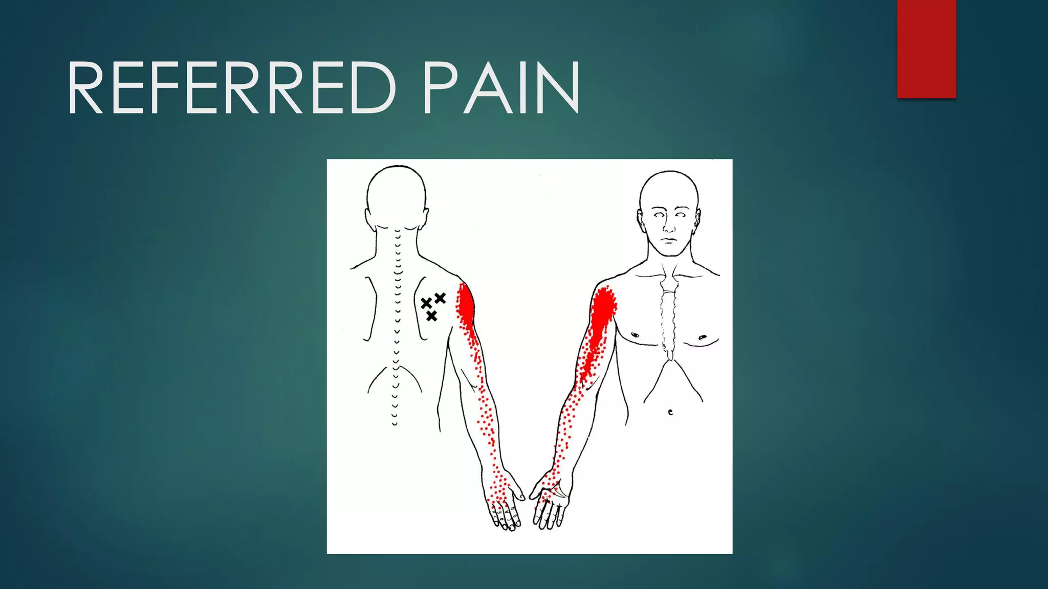 REFERRED PAIN
 