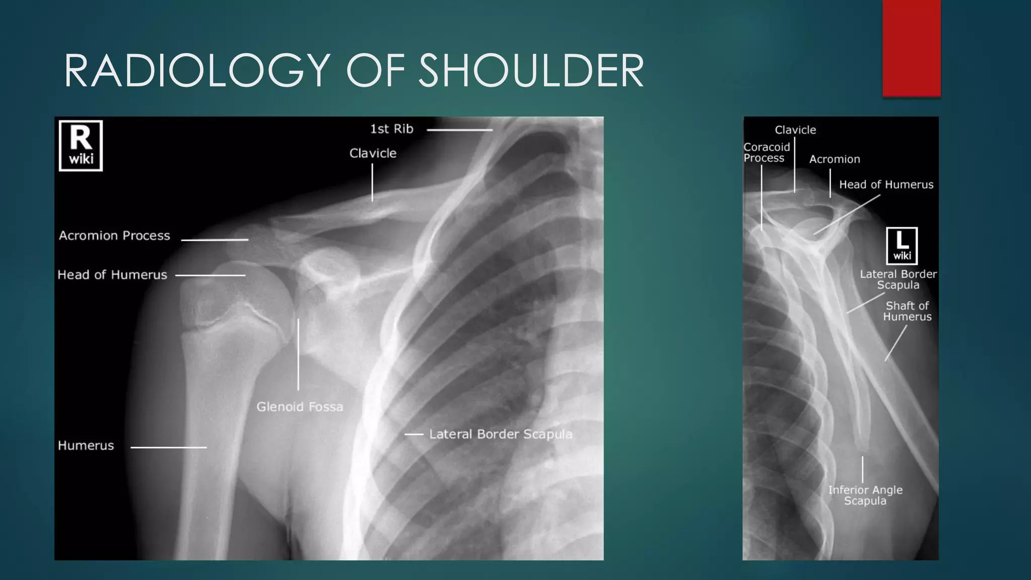 RADIOLOGY OF SHOULDER
 