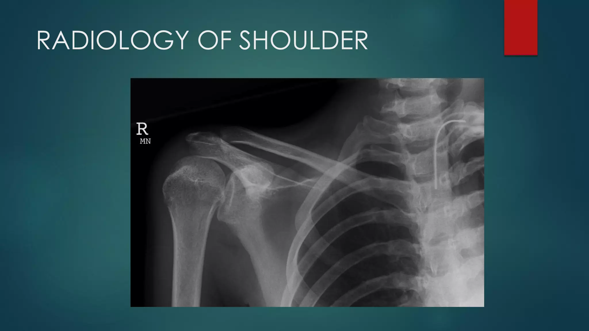RADIOLOGY OF SHOULDER
 