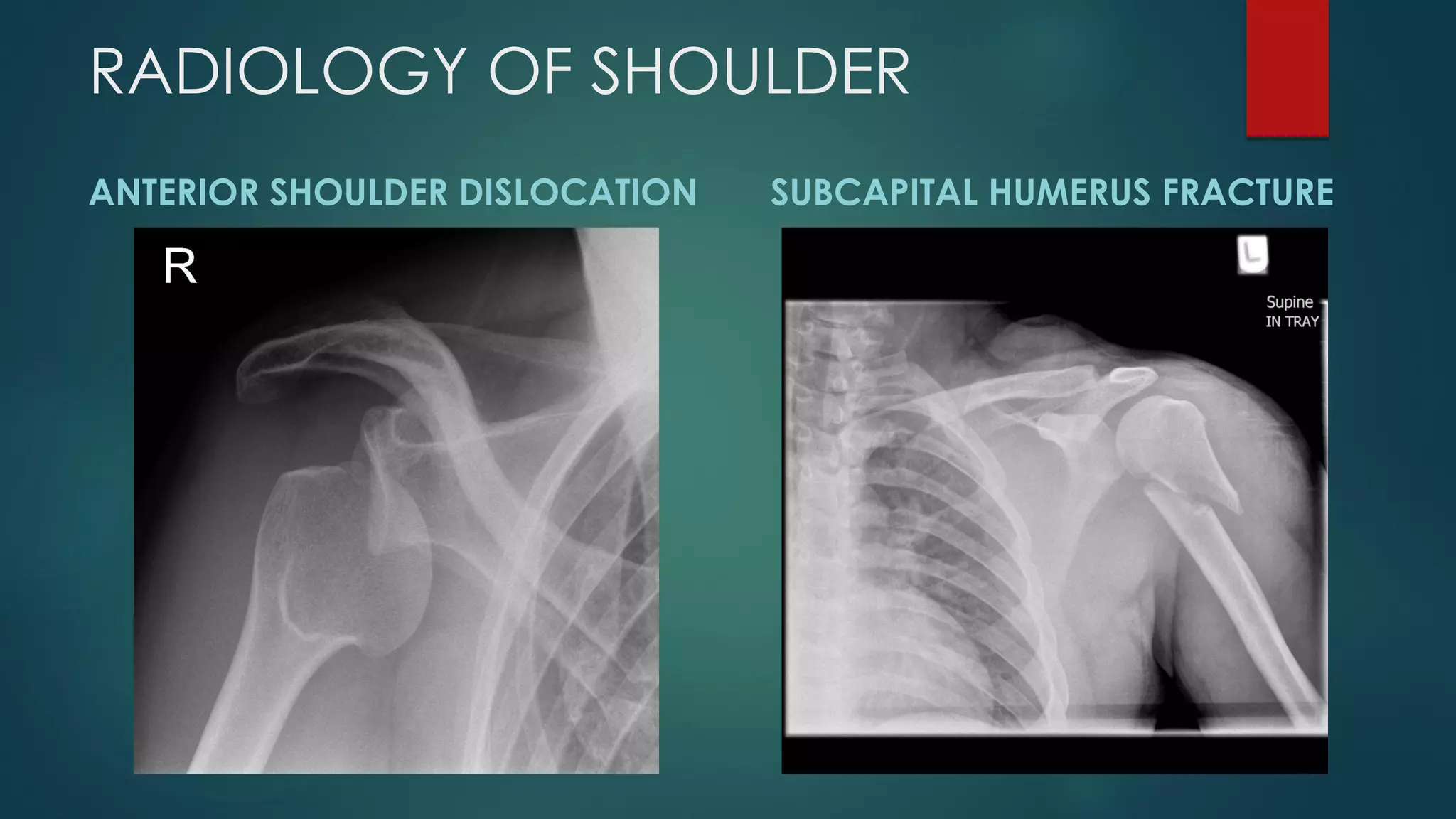 RADIOLOGY OF SHOULDER
ANTERIOR SHOULDER DISLOCATION SUBCAPITAL HUMERUS FRACTURE
 