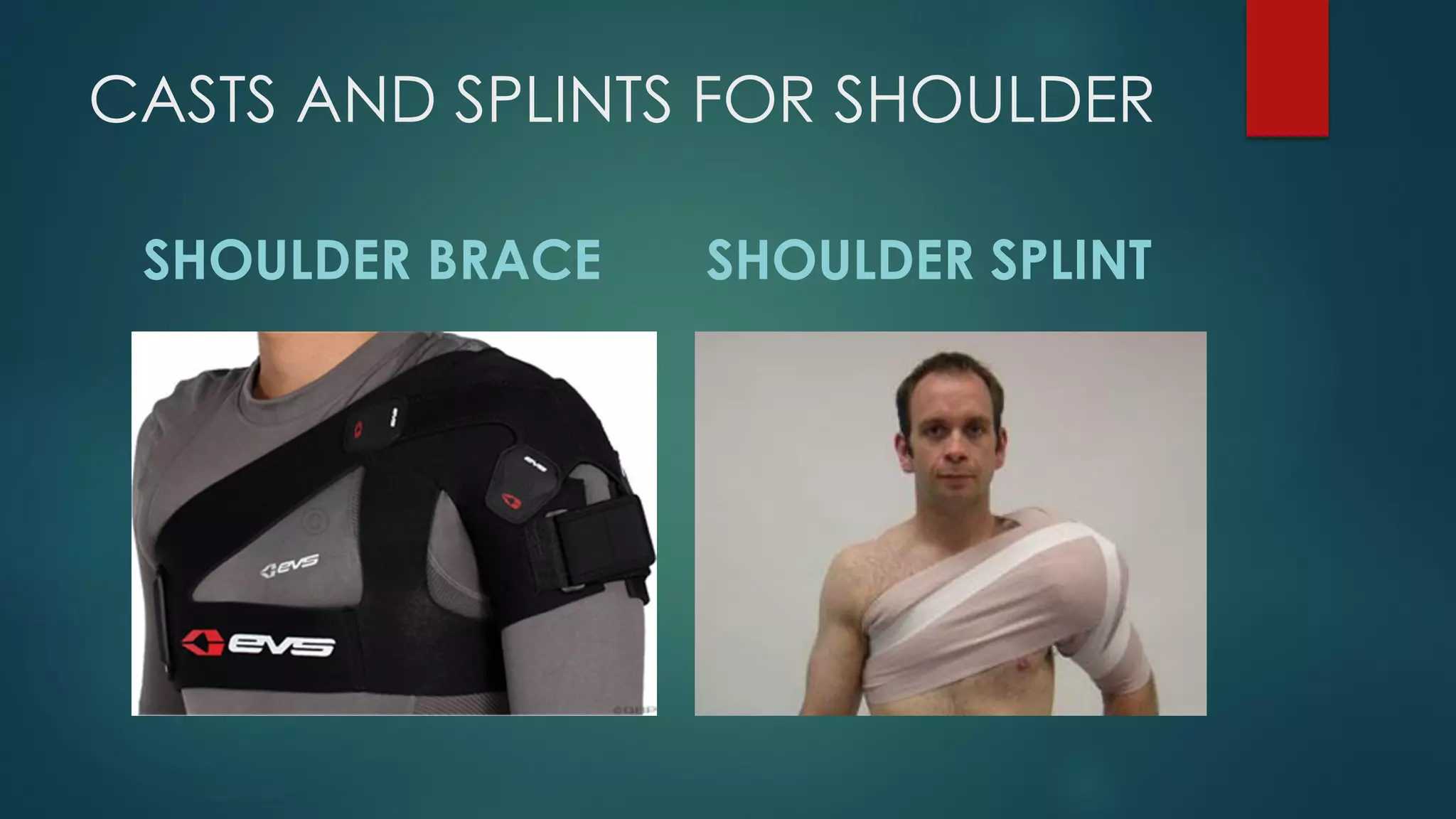 CASTS AND SPLINTS FOR SHOULDER
SHOULDER BRACE SHOULDER SPLINT
 