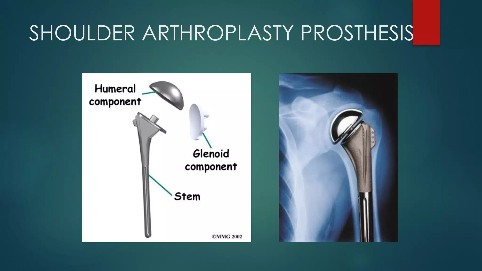 SHOULDER ARTHROPLASTY PROSTHESIS
 