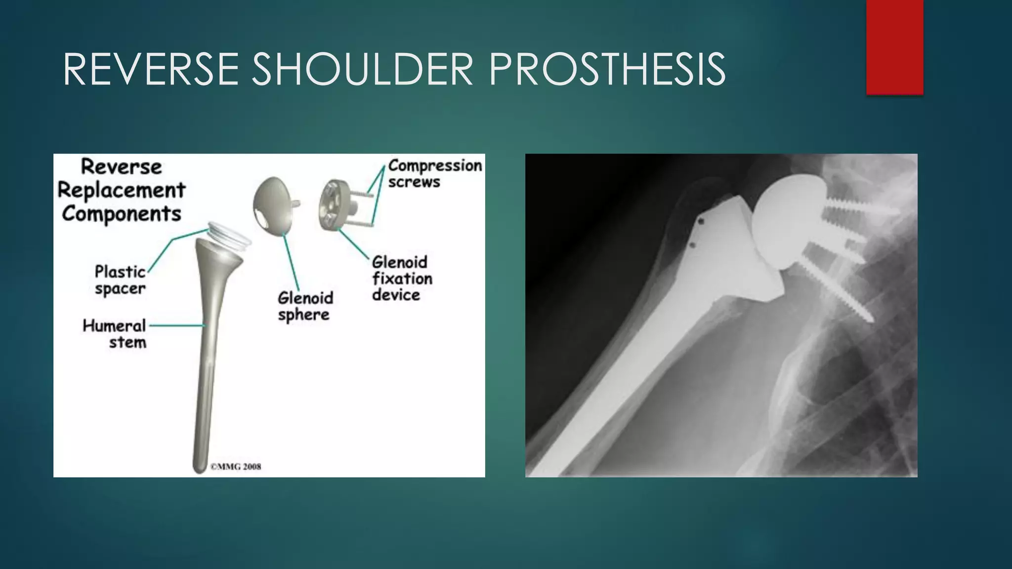 REVERSE SHOULDER PROSTHESIS
 