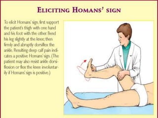 Homan Sign Example General History taking and physical examinatin | PPTX
