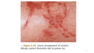 Linear Rash Diffuse Approach to the diagnosis of dermatological disease | PPTX