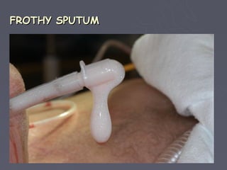 FROTHY SPUTUM
 